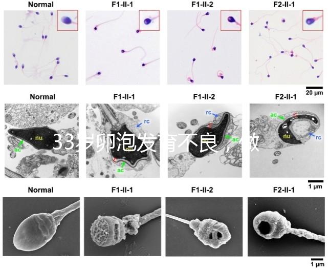 33歲卵泡發育不良，做試管黃體期促排方案失敗怎么辦？